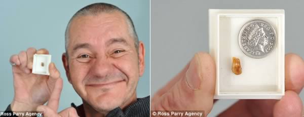 Людині видалили зуб з вуха, який мучив його протягом 3 десятиліть