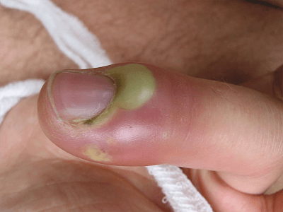 Гострий запальний процес, що виникає в тканинах пальців, називають   панарицием